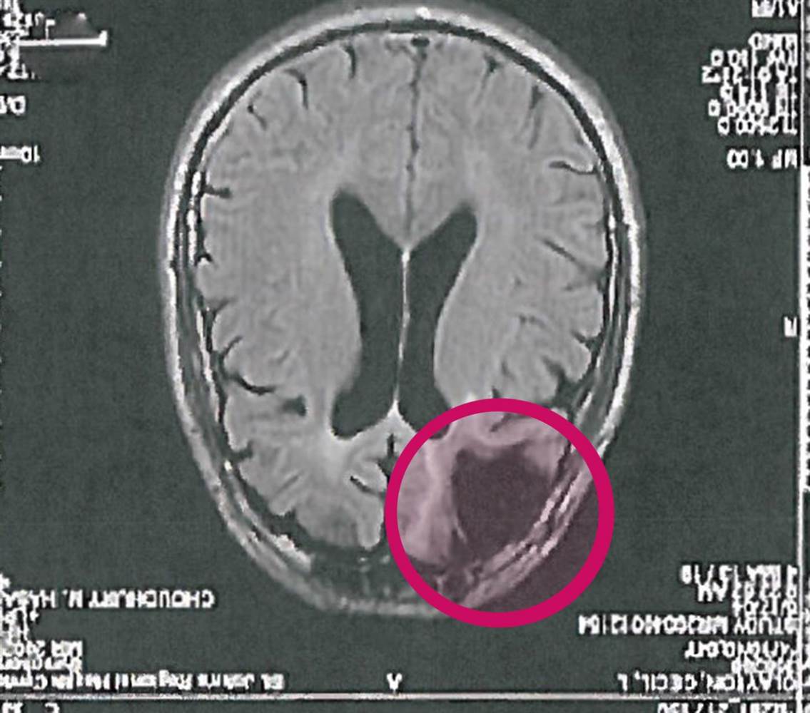 Images of Brain Damage | 1135x1000