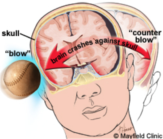 Amazing Concussion Pictures & Backgrounds