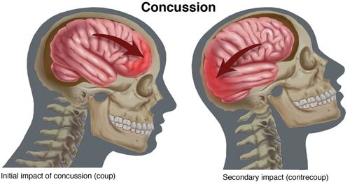 Concussion #12
