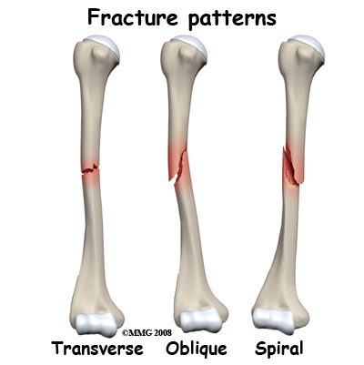 Fracture #2